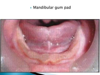  Mandibular gum pad
 