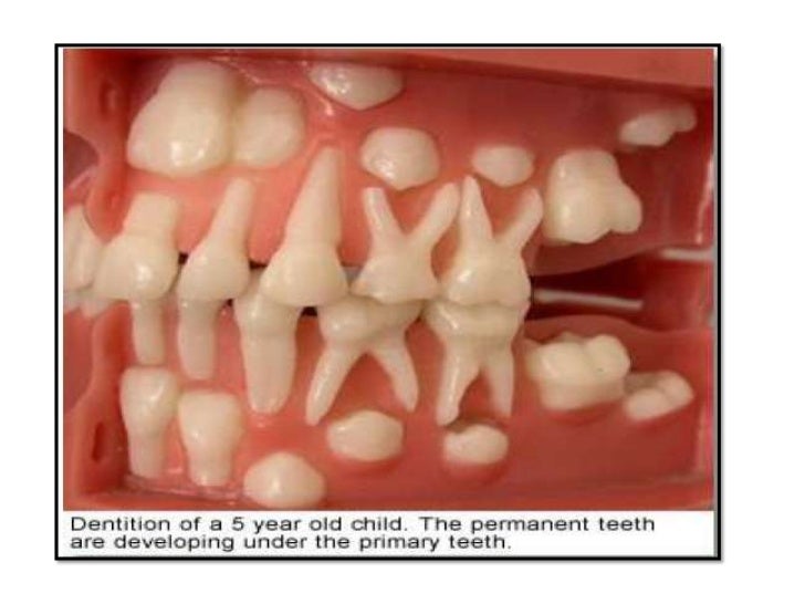 Erupting 6 Year Old Molars Pictures Teethwalls