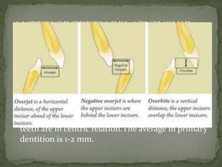 Overbite Distance Development of occlusion | PPTX