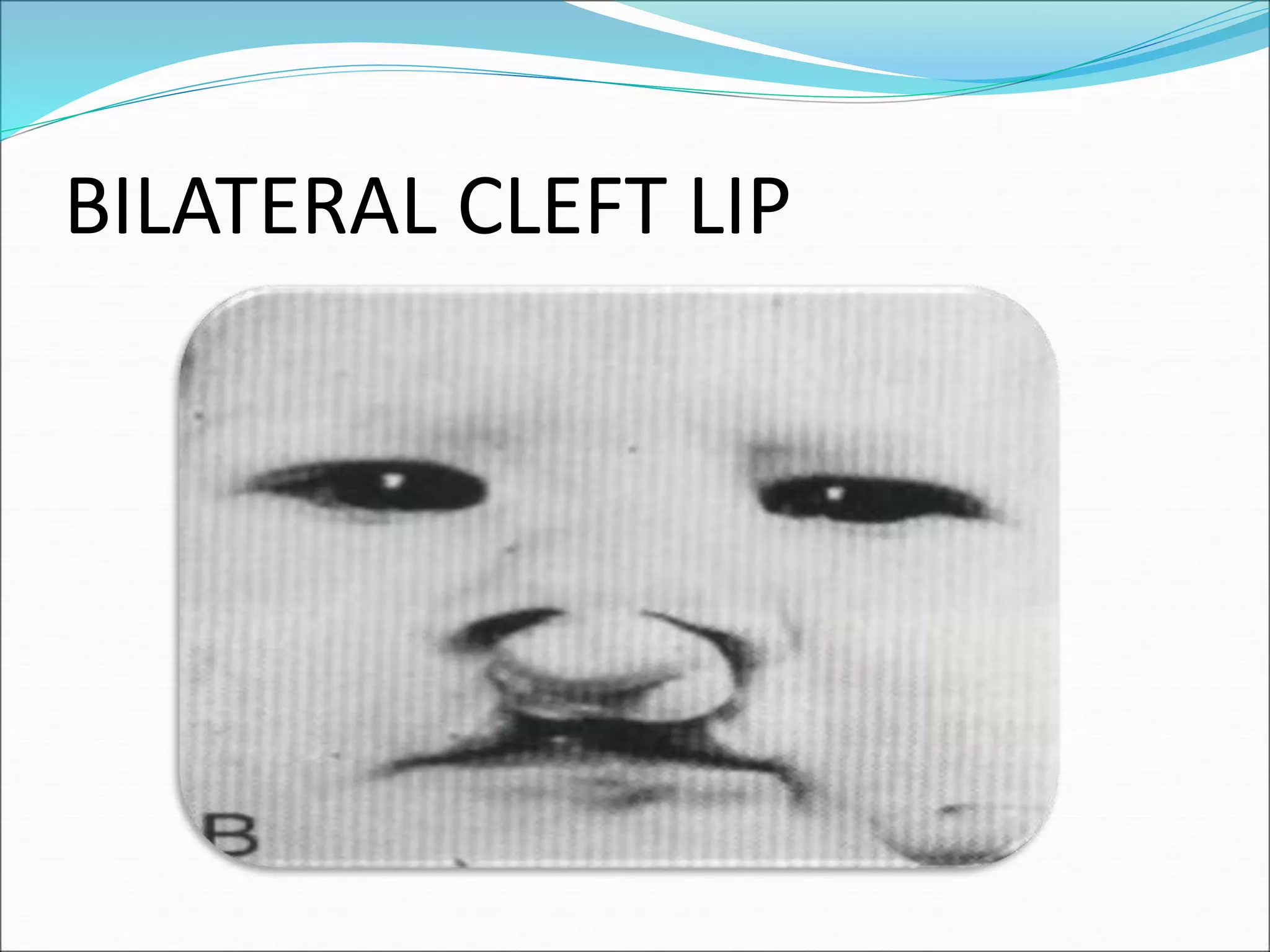BILATERAL CLEFT LIP
 