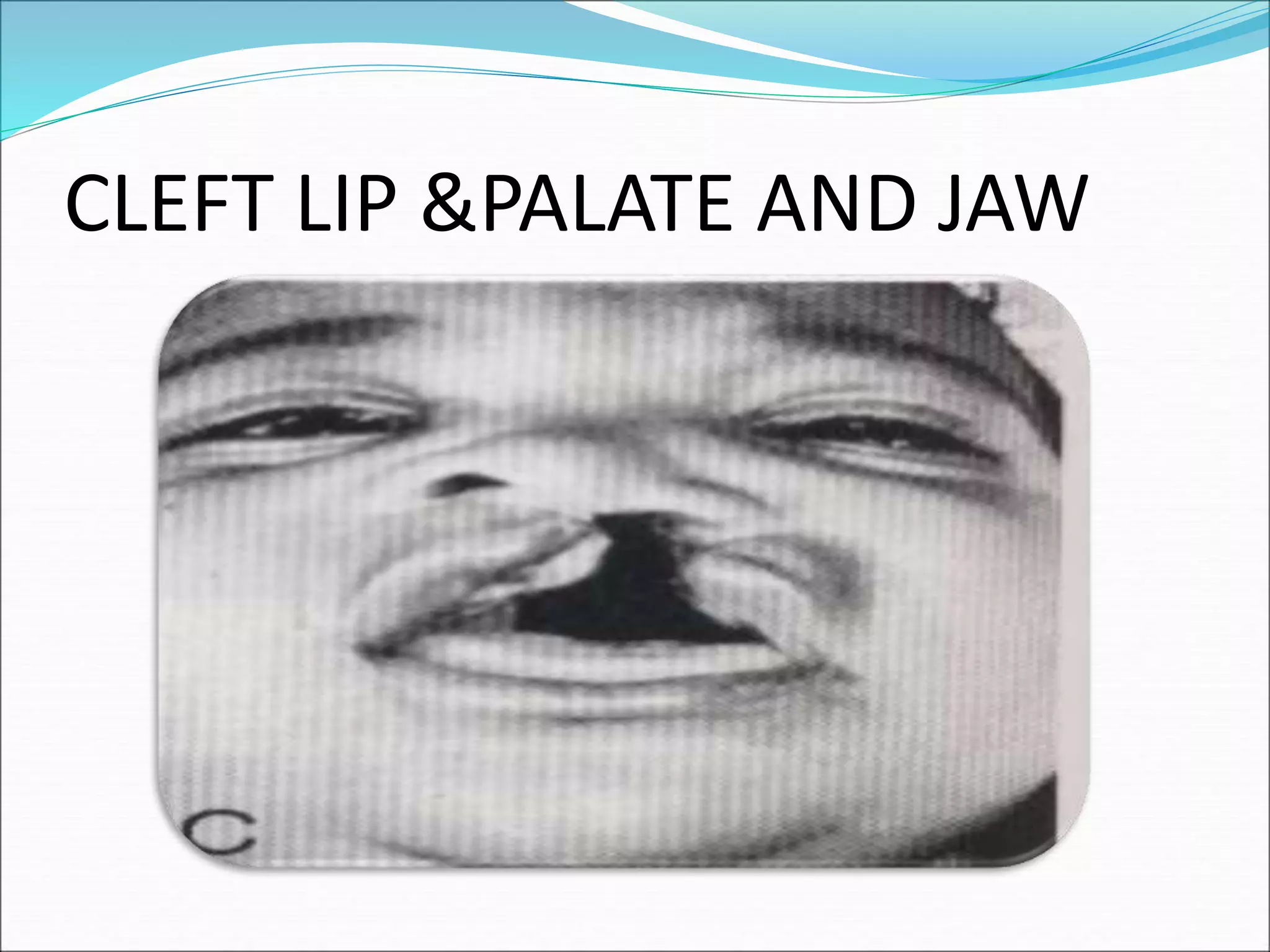 CLEFT LIP &PALATE AND JAW
 