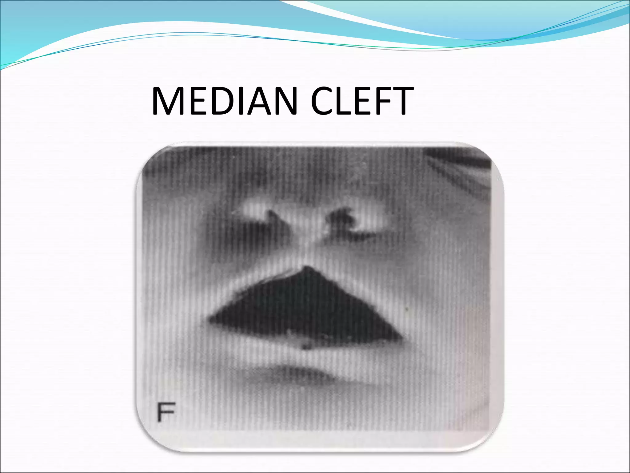 MEDIAN CLEFT
 