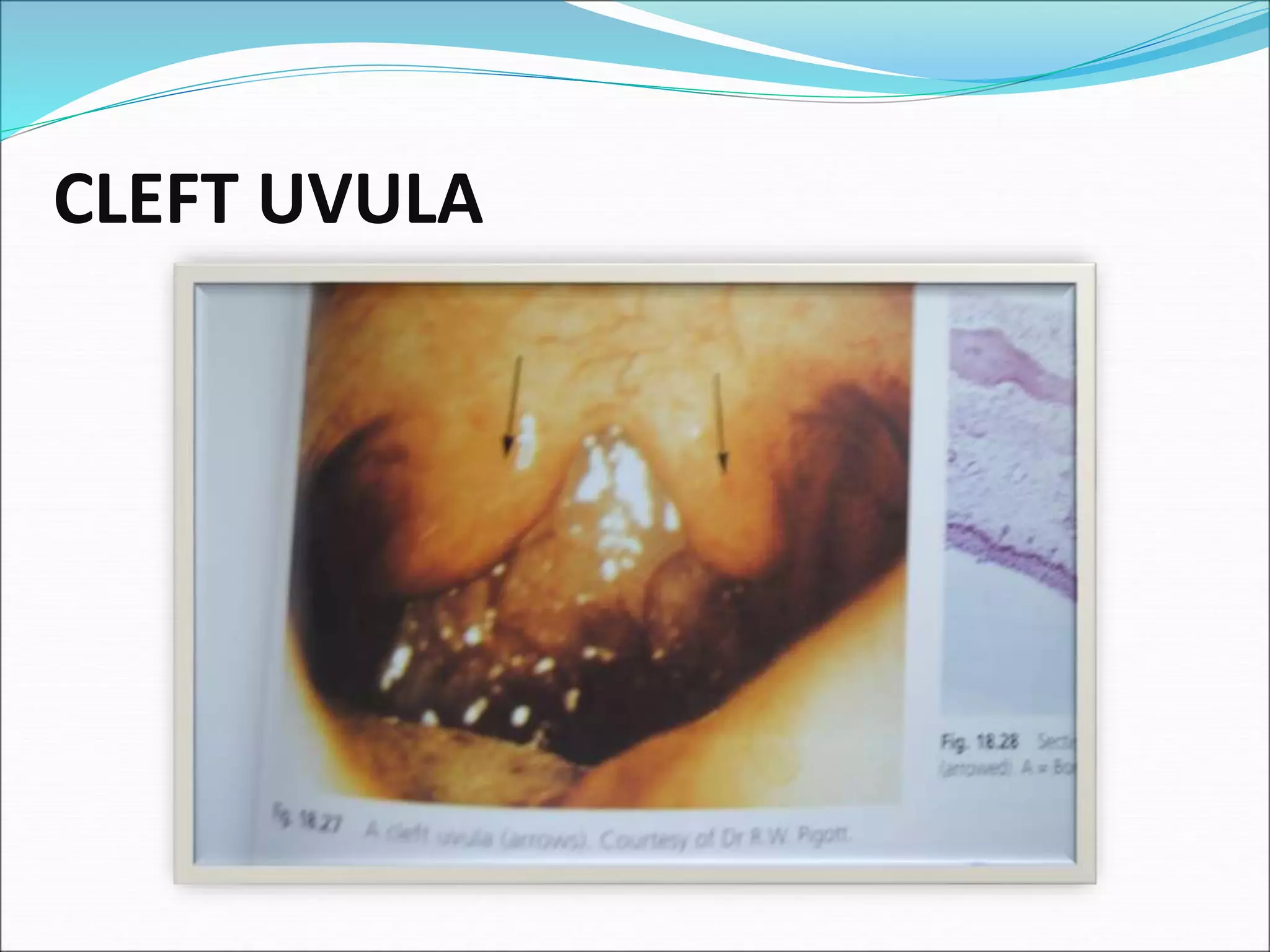 CLEFT UVULA
 