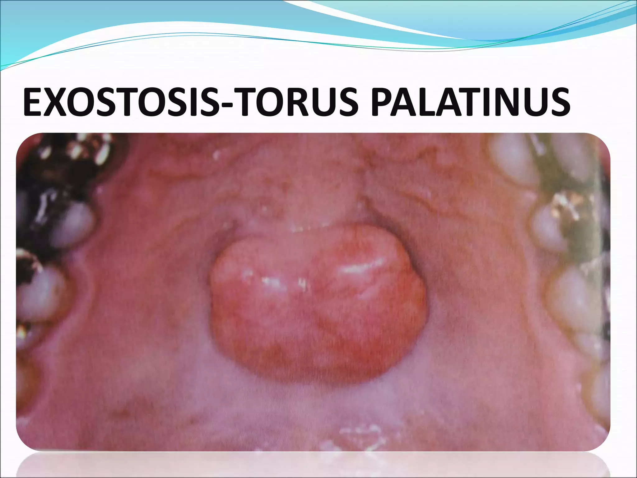 EXOSTOSIS-TORUS PALATINUS
 