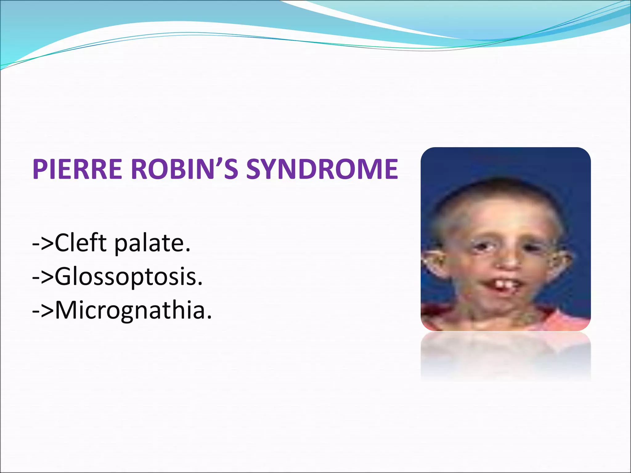 PIERRE ROBIN’S SYNDROME
->Cleft palate.
->Glossoptosis.
->Micrognathia.
 