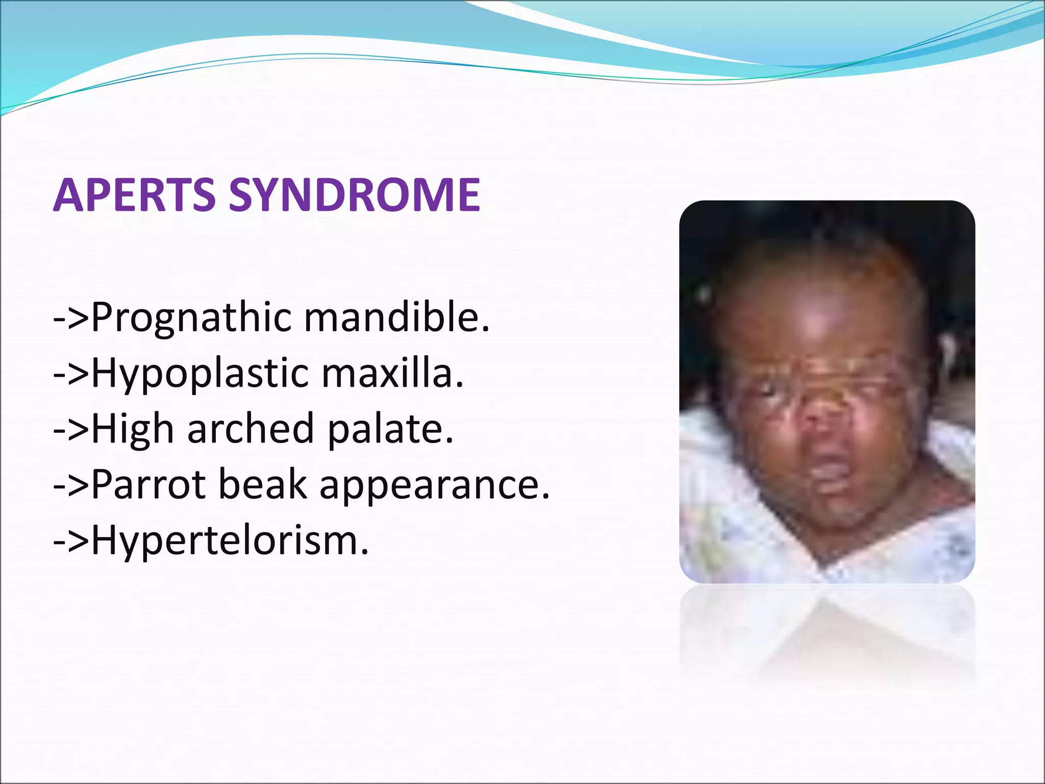 APERTS SYNDROME
->Prognathic mandible.
->Hypoplastic maxilla.
->High arched palate.
->Parrot beak appearance.
->Hypertelorism.
 
