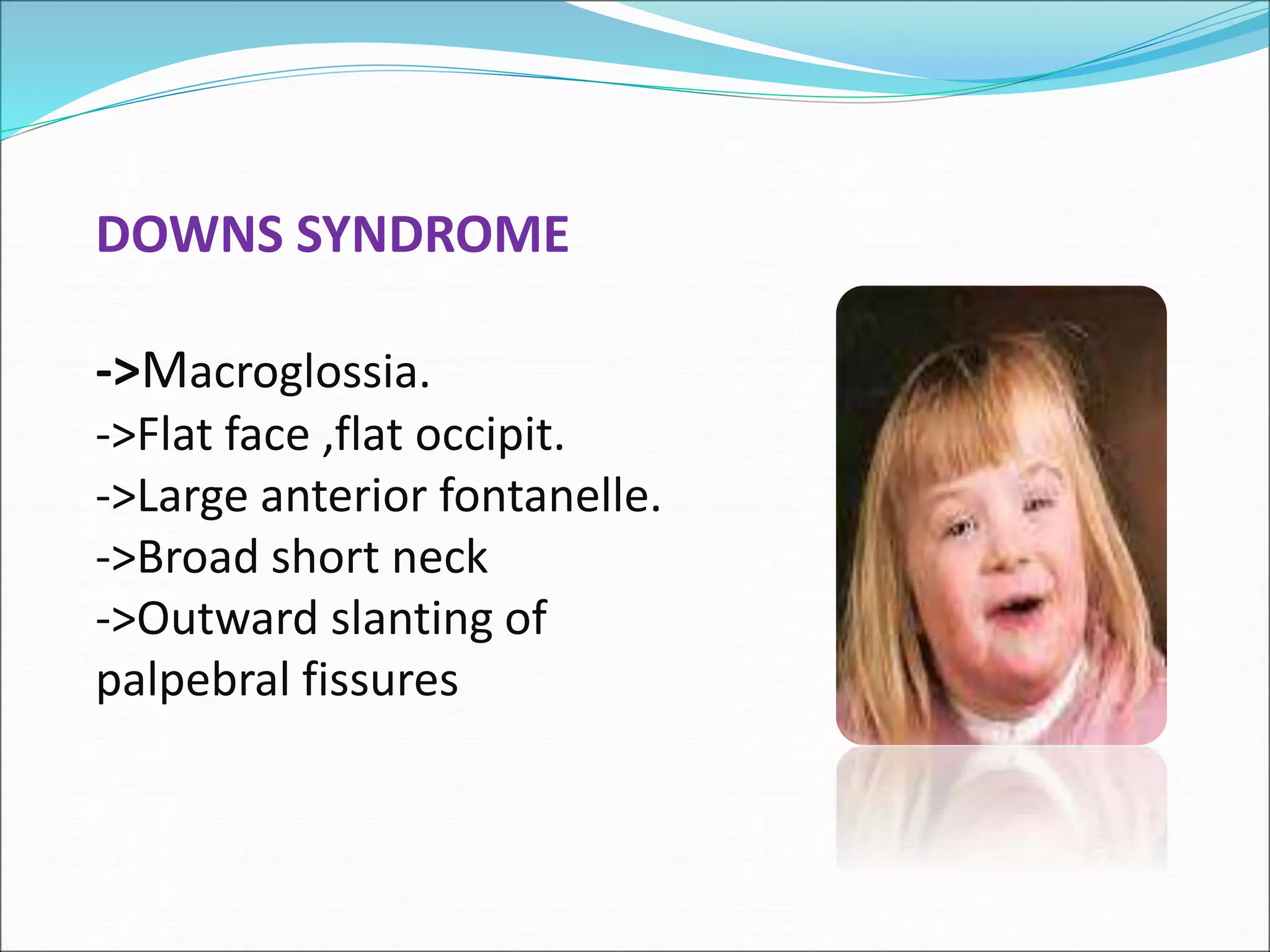 DOWNS SYNDROME
->Macroglossia.
->Flat face ,flat occipit.
->Large anterior fontanelle.
->Broad short neck
->Outward slanting of
palpebral fissures
 