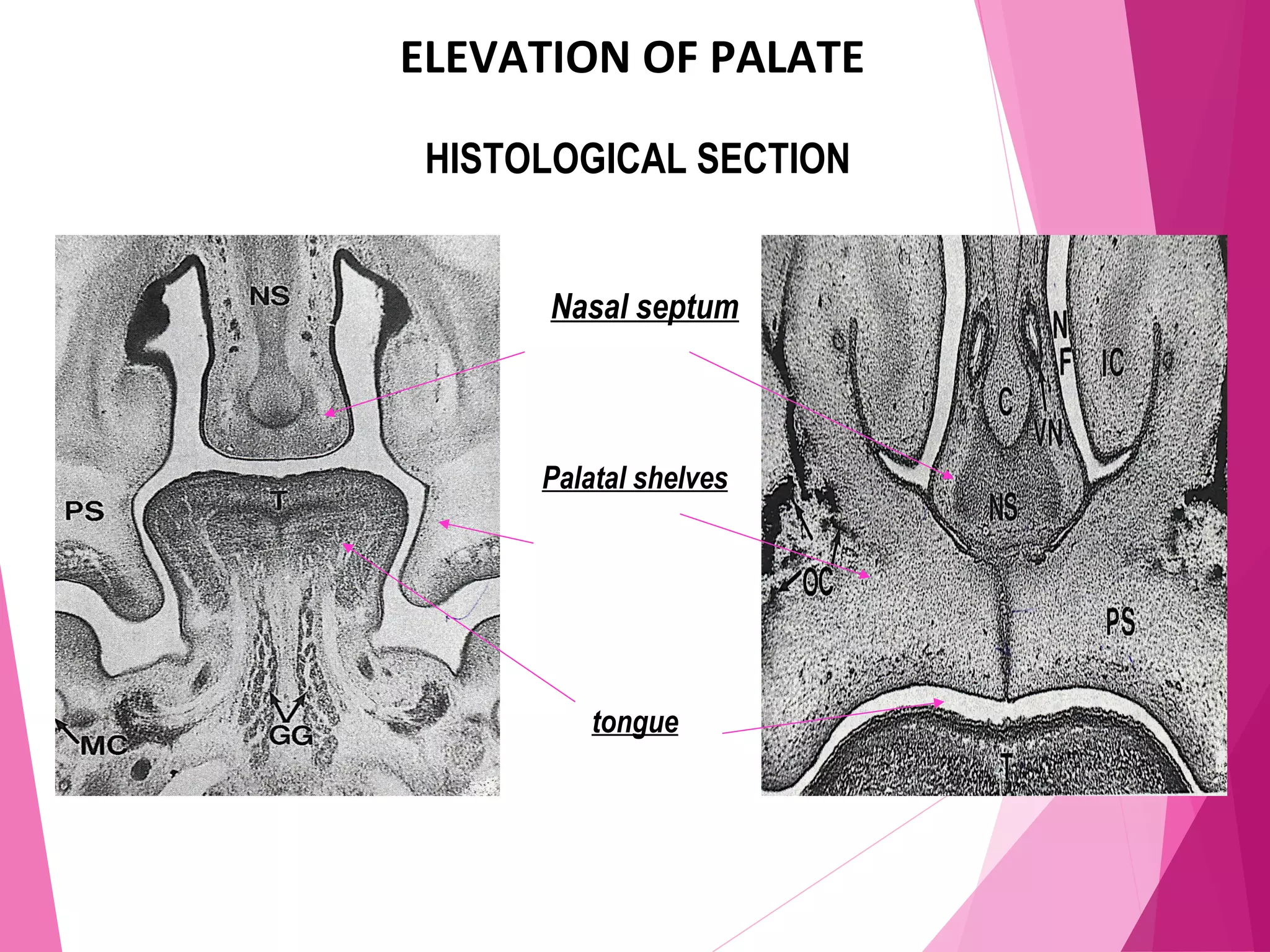 ELEVATION OF PALATE
HISTOLOGICAL SECTION
Nasal septum
Palatal shelves
tongue
 