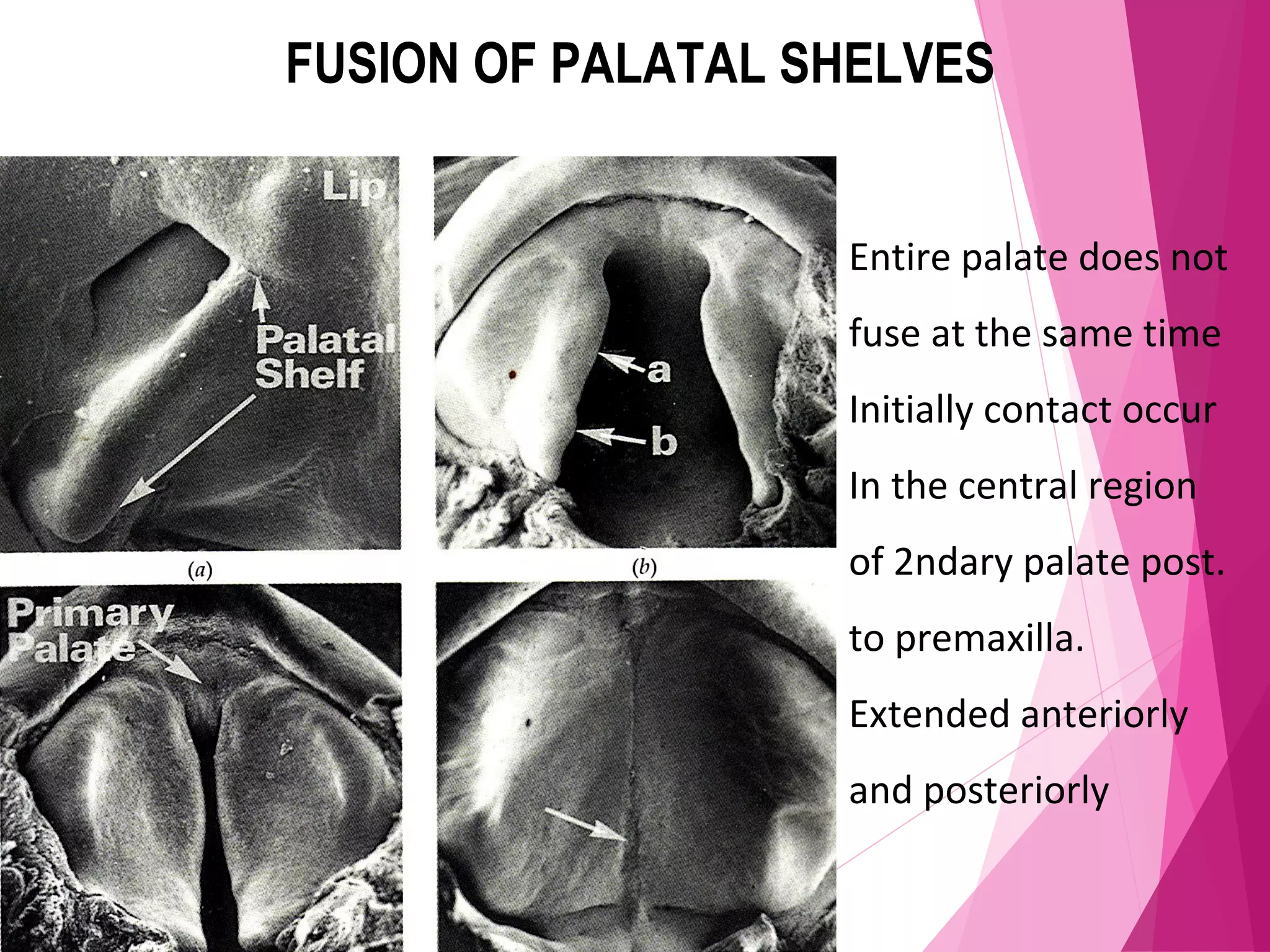 FUSION OF PALATAL SHELVES
Entire palate does not
fuse at the same time
Initially contact occur
In the central region
of 2ndary palate post.
to premaxilla.
Extended anteriorly
and posteriorly
 