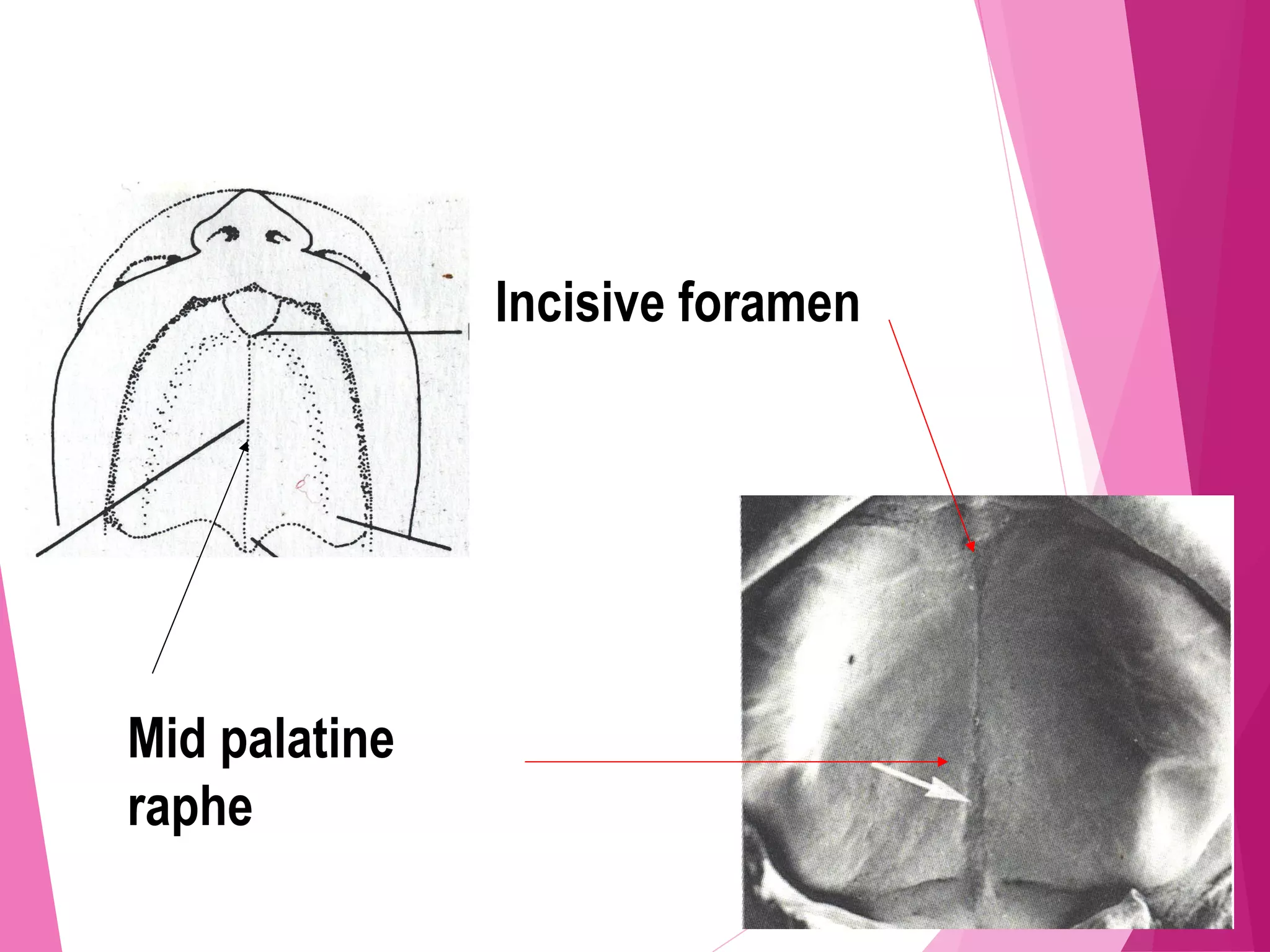Mid palatine
raphe
Incisive foramen
 