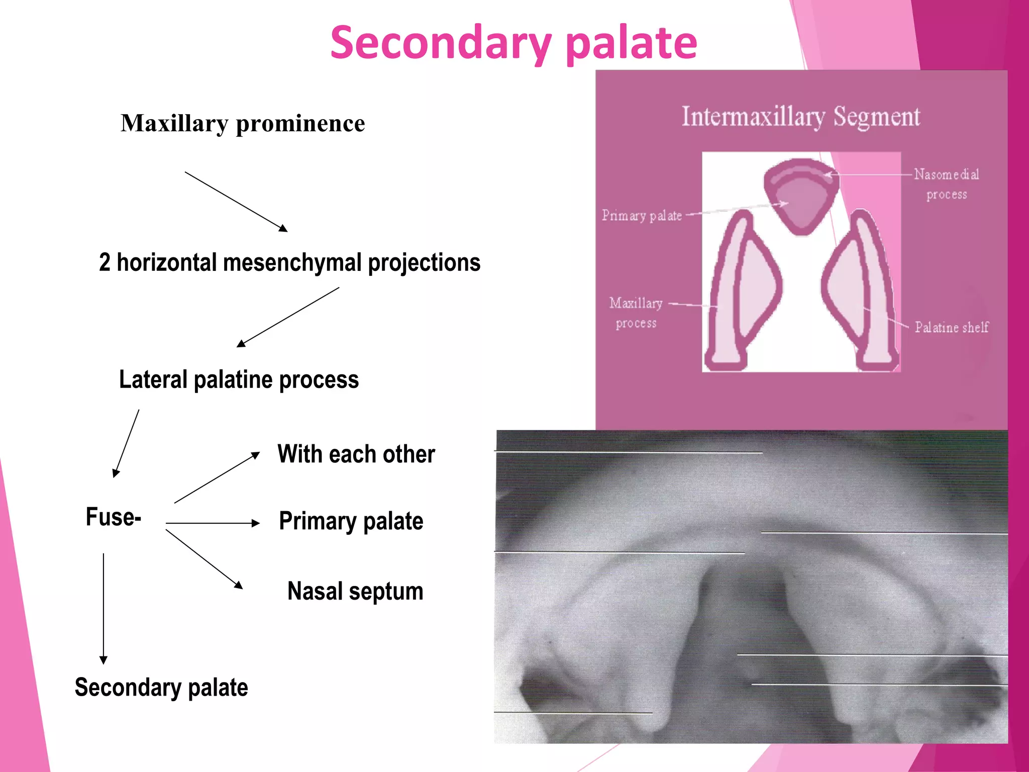 Secondary palate
Maxillary prominence
2 horizontal mesenchymal projections
With each other
Primary palate
Secondary palate
Lateral palatine process
Fuse-
Nasal septum
 