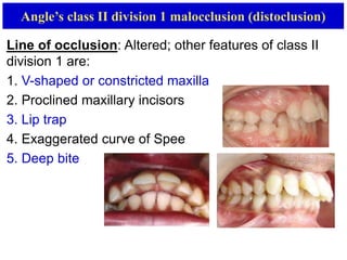 classifcation of malocclusion | PPTX