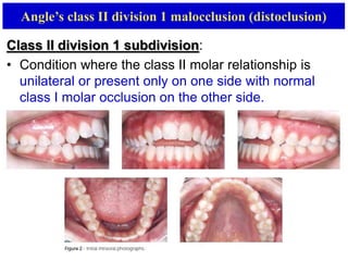 classifcation of malocclusion | PPTX