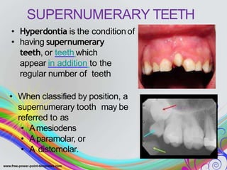 SUPERNUMERARY TEETH
• Hyperdontia is the condition of
• having supernumerary
teeth, or teeth which
appear in addition to the
regular number of teeth
• When classified by position, a
supernumerary tooth may be
referred to as
• Amesiodens
• Aparamolar, or
• A distomolar.
 