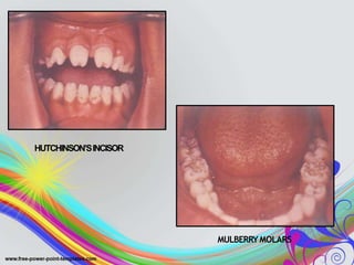 HUTCHINSON’SINCISOR
MULBERRYMOLARS
 