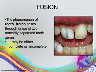 FUSION
•The phenomenon of
tooth fusion arises
through union of two
normally separated tooth
germs
• it may be either
complete or incomplete.
 