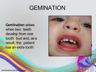 GEMINATION
Gemination arises
when two teeth
develop from one
tooth bud and, asa
result, the patient
has an extra tooth
 