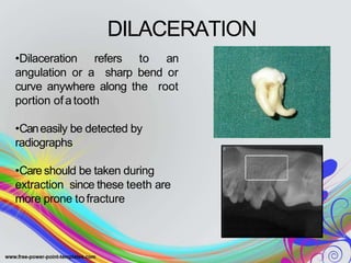 DILACERATION
•Dilaceration refers to an
angulation or a sharp bend or
curve anywhere along the root
portion ofatooth
•Caneasily be detected by
radiographs
•Careshould be taken during
extraction since these teeth are
more prone tofracture
 