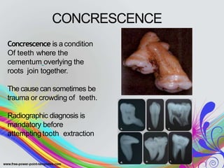 CONCRESCENCE
Concrescence is a condition
Of teeth where the
cementum overlying the
roots join together.
The cause can sometimes be
trauma or crowding of teeth.
Radiographic diagnosis is
mandatory before
attemptingtooth extraction
 