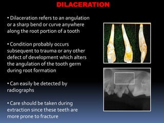 Sharp Linear Defect Tooth Development of teeth and developmental defects | PPTX
