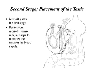 Second Stage: Placement of the Testis
 6 months after
the first stage
 Peritoneum
incised tennis-
racquet shape to
mobilize the
testis on its blood
supply.
 