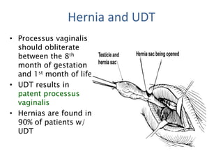 Hernia and UDT
• Processus vaginalis
should obliterate
between the 8th
month of gestation
and 1st month of life
• UDT results in
patent processus
vaginalis
• Hernias are found in
90% of patients w/
UDT
 