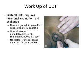 Work Up of UDT
• Bilateral UDT requires
hormonal evaluation and
challenge
– Elevated gonadotropins (FSH)
suggest bilateral anorchia
– Normal serum
gonadotropins=>hCG
challenge (2000 IU x 3days)
– No testosterone response
indicates bilateral anorchia
 