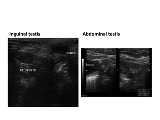 Inguinal testis Abdominal testis
 