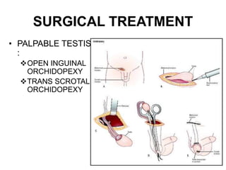 SURGICAL TREATMENT
• PALPABLE TESTIS
:
OPEN INGUINAL
ORCHIDOPEXY
TRANS SCROTAL
ORCHIDOPEXY
 