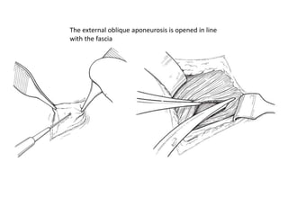 The external oblique aponeurosis is opened in line
with the fascia
 