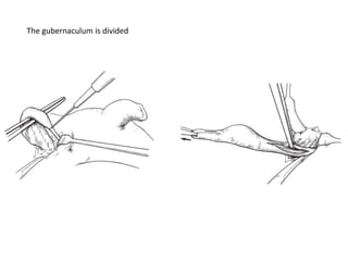 The gubernaculum is divided
 