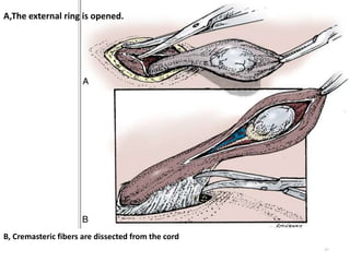 81
A,The external ring is opened.
B, Cremasteric fibers are dissected from the cord
 