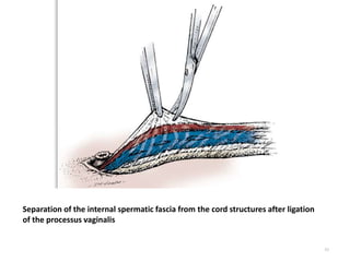 83
Separation of the internal spermatic fascia from the cord structures after ligation
of the processus vaginalis
 