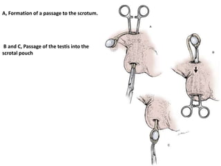 86
A, Formation of a passage to the scrotum.
B and C, Passage of the testis into the
scrotal pouch
 