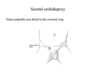 Scrotal orchidopexy
Testes palpable just distal to the external ring
 