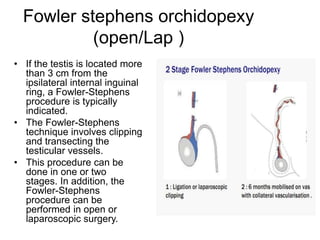 Fowler stephens orchidopexy
(open/Lap )
• If the testis is located more
than 3 cm from the
ipsilateral internal inguinal
ring, a Fowler-Stephens
procedure is typically
indicated.
• The Fowler-Stephens
technique involves clipping
and transecting the
testicular vessels.
• This procedure can be
done in one or two
stages. In addition, the
Fowler-Stephens
procedure can be
performed in open or
laparoscopic surgery.
 