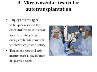 3. Microvascular testicular
autotransplantation
• Employs microsurgical
techniques reserved for
older children with internal
spermatic artery large
enough to be anastomosed
to inferior epigastric artery
• Testicular artery and vein
anastomosed to the inferior
epigastric vessels .
 