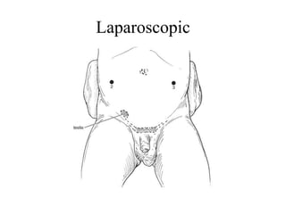 Laparoscopic
 