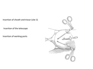 Insertion of sheath and trocar (site 1)
Insertion of the telescope
Insertion of working ports
 