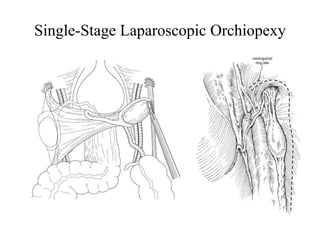 Single-Stage Laparoscopic Orchiopexy
 