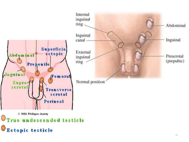 Development Of Testis Cryptorchidism Presentation
