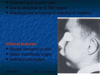 29/07/2017 BY - Dr. Sanjana G. Patil 101
 Acquired type is post natal –
 Due to disturbance in TMJ region.
 Ankylosis due to trauma or infection of mastoid.
Clinical features
 Severe retrusion of chin
 Steep mandibular angle
 Deficient chin button.
 