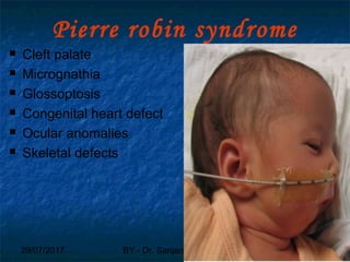 29/07/2017 BY - Dr. Sanjana G. Patil 102
Pierre robin syndrome
 Cleft palate
 Micrognathia
 Glossoptosis
 Congenital heart defect
 Ocular anomalies
 Skeletal defects
 