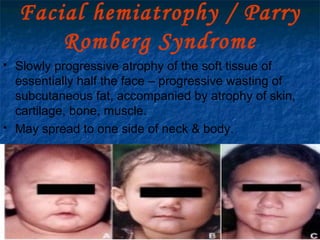 29/07/2017 BY - Dr. Sanjana G. Patil 109
Facial hemiatrophy / Parry
Romberg Syndrome
 Slowly progressive atrophy of the soft tissue of
essentially half the face – progressive wasting of
subcutaneous fat, accompanied by atrophy of skin,
cartilage, bone, muscle.
 May spread to one side of neck & body.
 