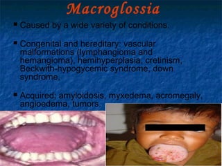 29/07/2017 BY - Dr. Sanjana G. Patil 115
Macroglossia
 Caused by a wide variety of conditions.
 Congenital and hereditary: vascular
malformations (lymphangioma and
hemangioma), hemihyperplasia, cretinism,
Beckwith-hypogycemic syndrome, down
syndrome,
 Acquired; amyloidosis, myxedema, acromegaly,
angioedema, tumors.
 