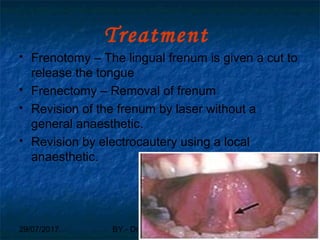 29/07/2017 BY - Dr. Sanjana G. Patil 117
Treatment
 Frenotomy – The lingual frenum is given a cut to
release the tongue
 Frenectomy – Removal of frenum
 Revision of the frenum by laser without a
general anaesthetic.
 Revision by electrocautery using a local
anaesthetic.
 