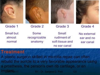 29/07/2017 BY - Dr. Sanjana G. Patil 120
Treatment
A plastic surgeon skilled in microtia repair can often
rebuild the auricle to a very favorable appearance using
a prosthesis, the person's own rib cartilage, or an
implant.
 