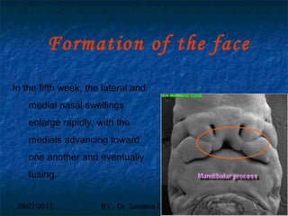 29/07/2017 BY - Dr. Sanjana G. Patil 24
Formation of the face
In the fifth week, the lateral and
medial nasal swellings
enlarge rapidly, with the
medials advancing toward
one another and eventually
fusing.
 