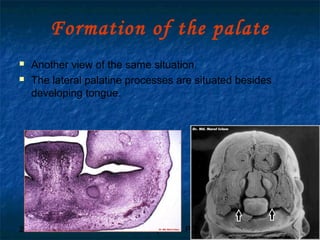 29/07/2017 BY - Dr. Sanjana G. Patil 34
Formation of the palate
 Another view of the same situation.
 The lateral palatine processes are situated besides
developing tongue.
 