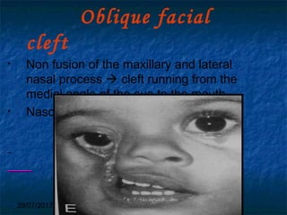 29/07/2017 BY - Dr. Sanjana G. Patil 69
Oblique facial
cleft
• Non fusion of the maxillary and lateral
nasal process  cleft running from the
medial angle of the eye to the mouth.
• Nasolacrimal duct not formed.
 